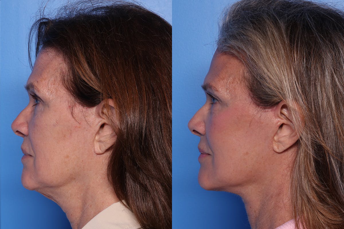 Facelift Before & After Gallery - Patient 342541 - Image 5