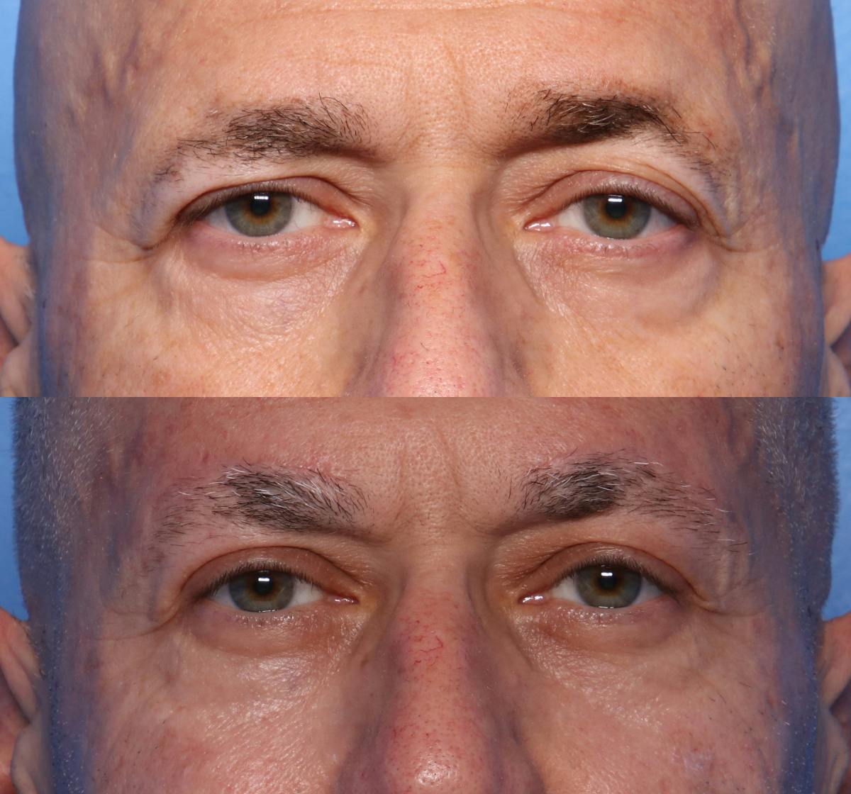 Brow Lift Before & After Gallery - Patient 501378 - Image 1