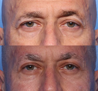 Brow Lift Before & After Gallery - Patient 501378 - Image 1