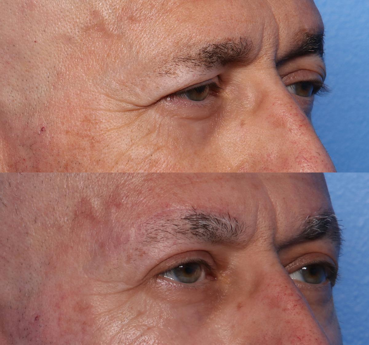 Brow Lift Before & After Gallery - Patient 501378 - Image 2