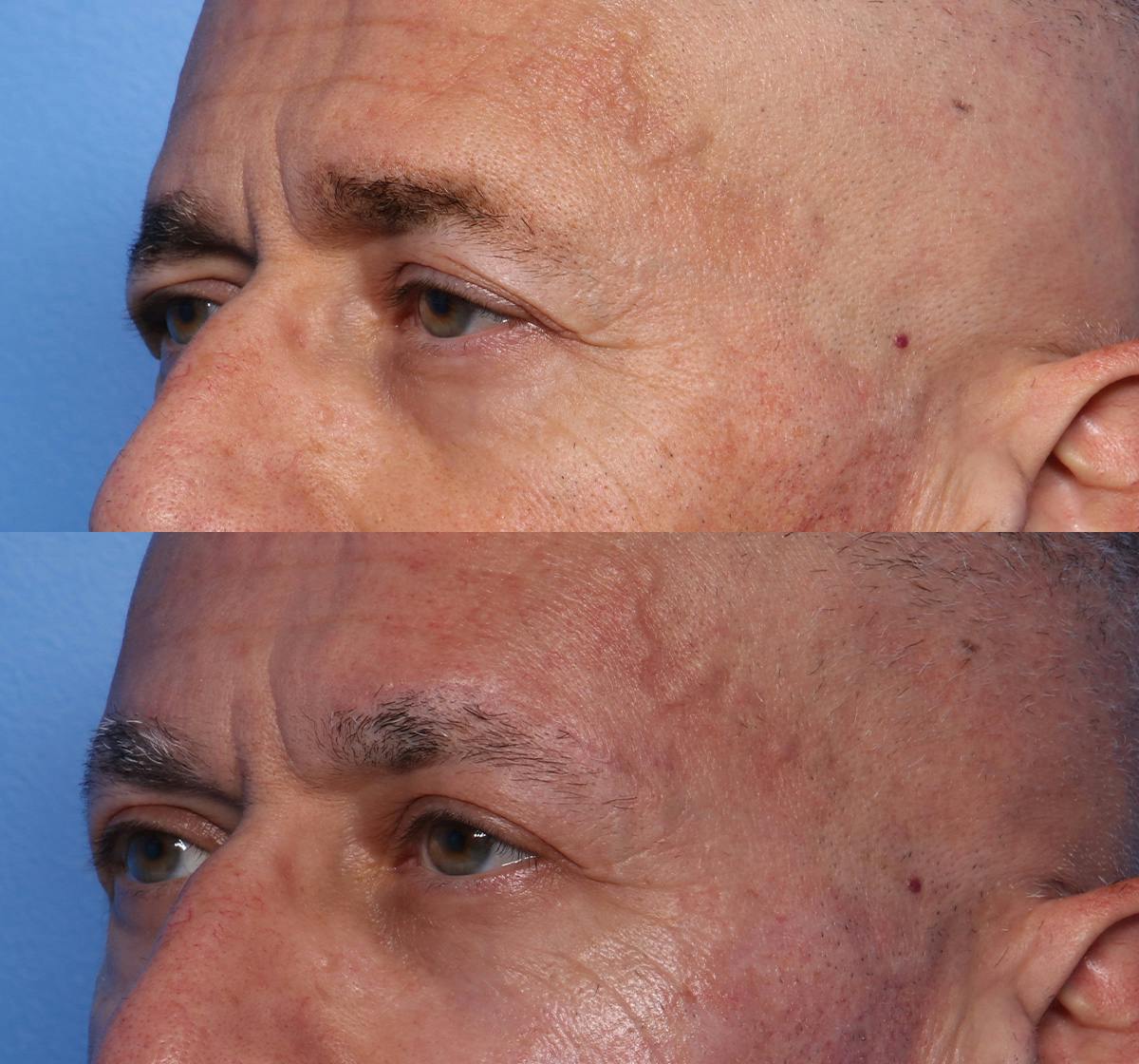 Brow Lift Before & After Gallery - Patient 501378 - Image 3