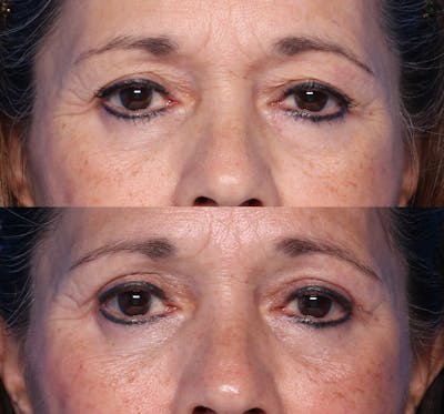 Blepharoplasty Before & After Gallery - Patient 122240 - Image 1