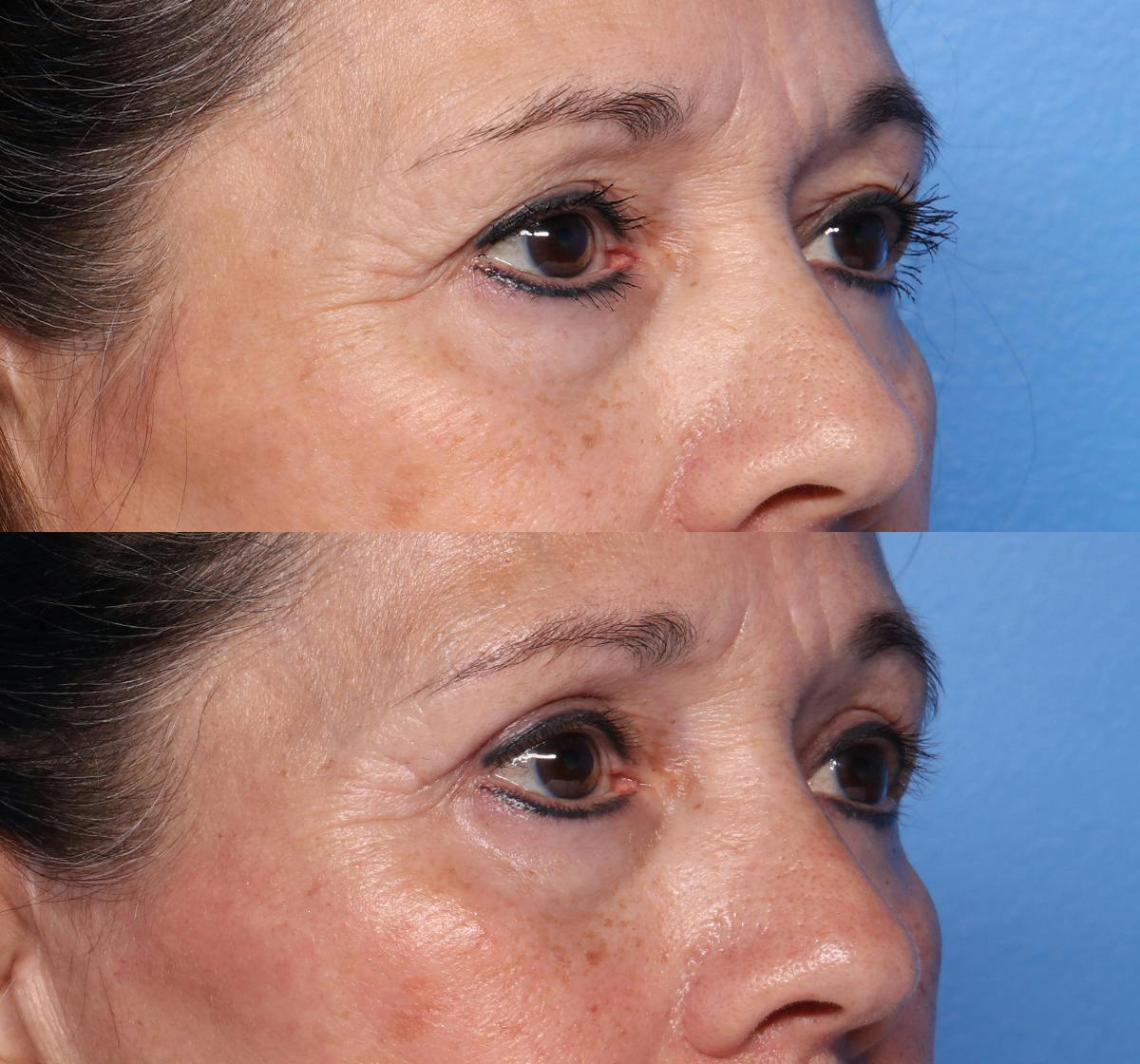 Blepharoplasty Before & After Gallery - Patient 122240 - Image 2