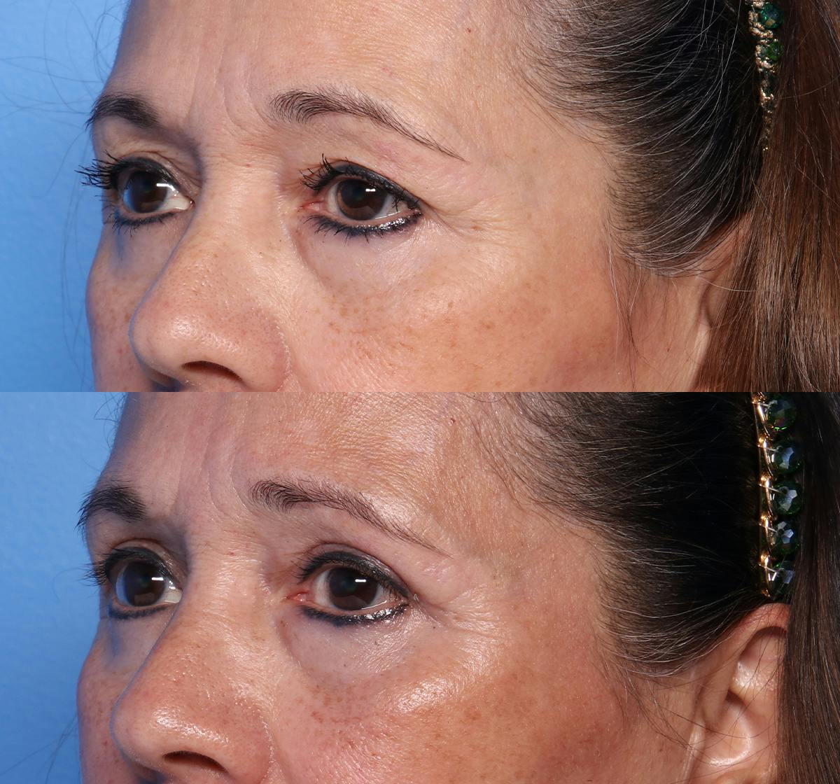 Blepharoplasty Before & After Gallery - Patient 122240 - Image 3