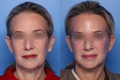Neck Lift Before & After Gallery - Patient 176012 - Image 1