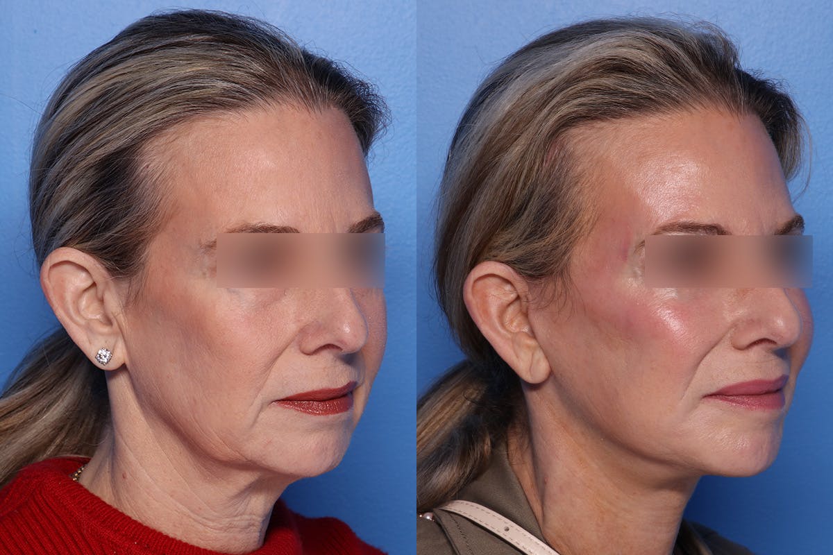 Neck Lift Before & After Gallery - Patient 176012 - Image 2