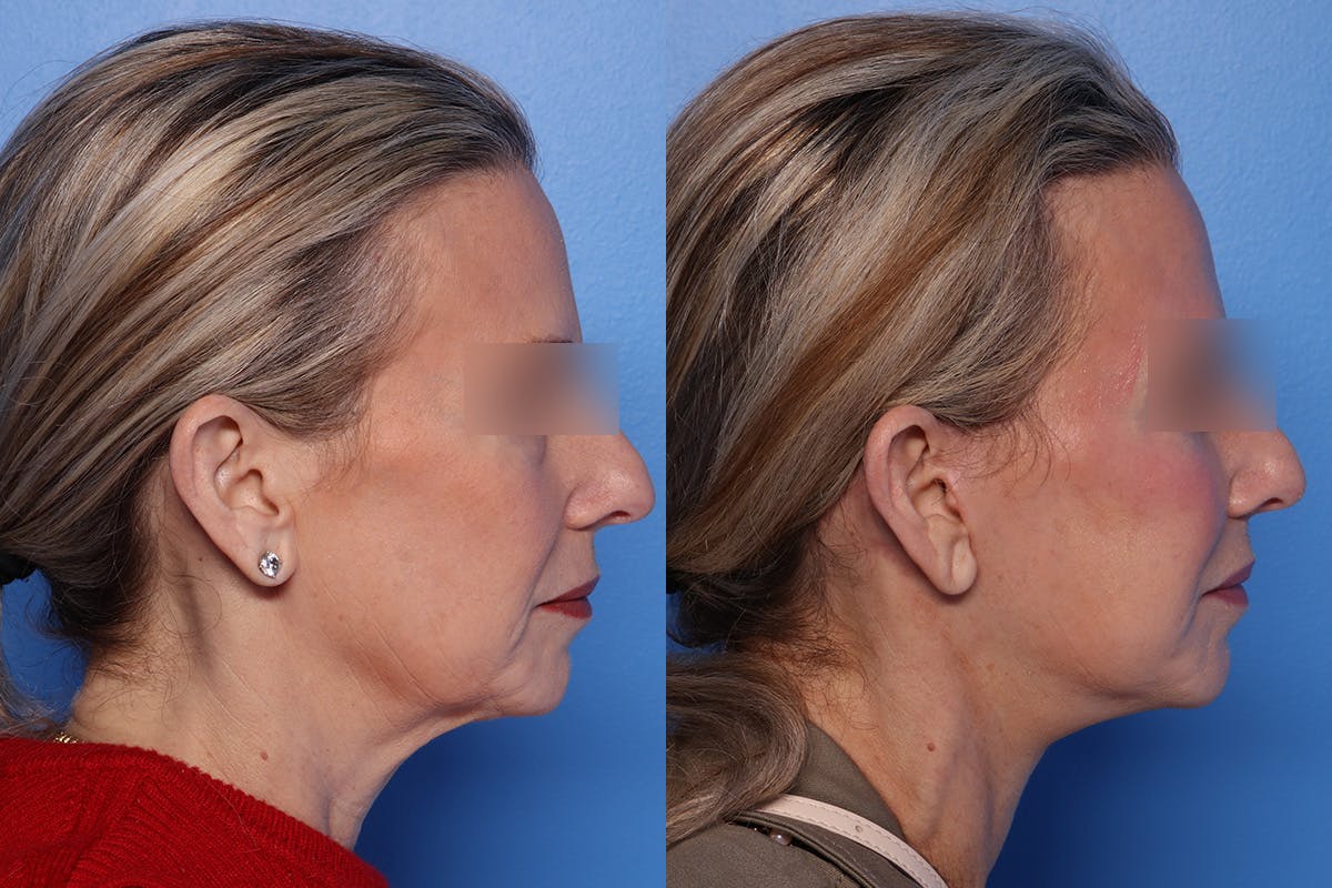 Neck Lift Before & After Gallery - Patient 176012 - Image 3
