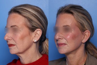 Neck Lift Before & After Gallery - Patient 176012 - Image 1
