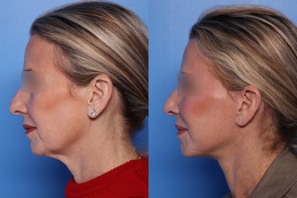 Neck Lift Before & After Gallery - Patient 176012 - Image 5