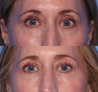 Blepharoplasty Before & After Gallery - Patient 242879 - Image 1
