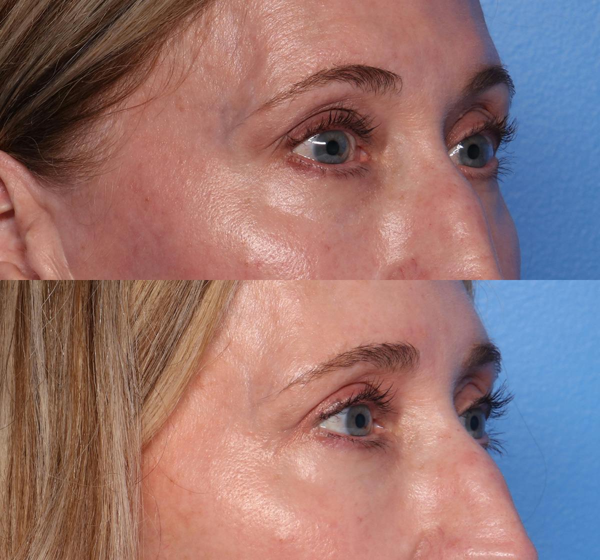 Blepharoplasty Before & After Gallery - Patient 242879 - Image 2