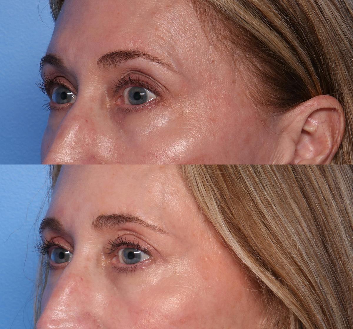 Blepharoplasty Before & After Gallery - Patient 242879 - Image 3