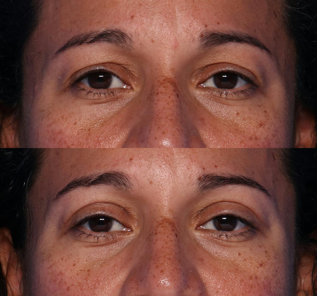 Blepharoplasty Before & After Gallery - Patient 289412 - Image 1