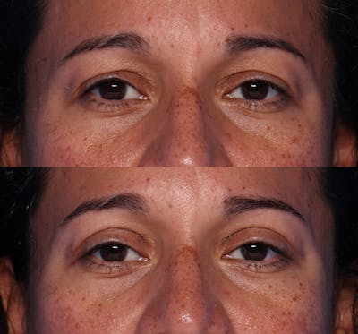 Blepharoplasty Before & After Gallery - Patient 289412 - Image 1