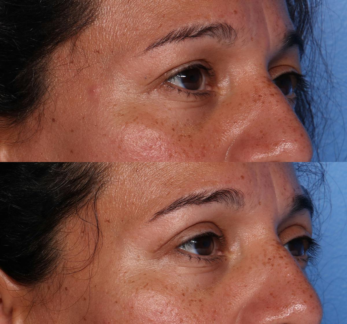 Blepharoplasty Before & After Gallery - Patient 289412 - Image 2