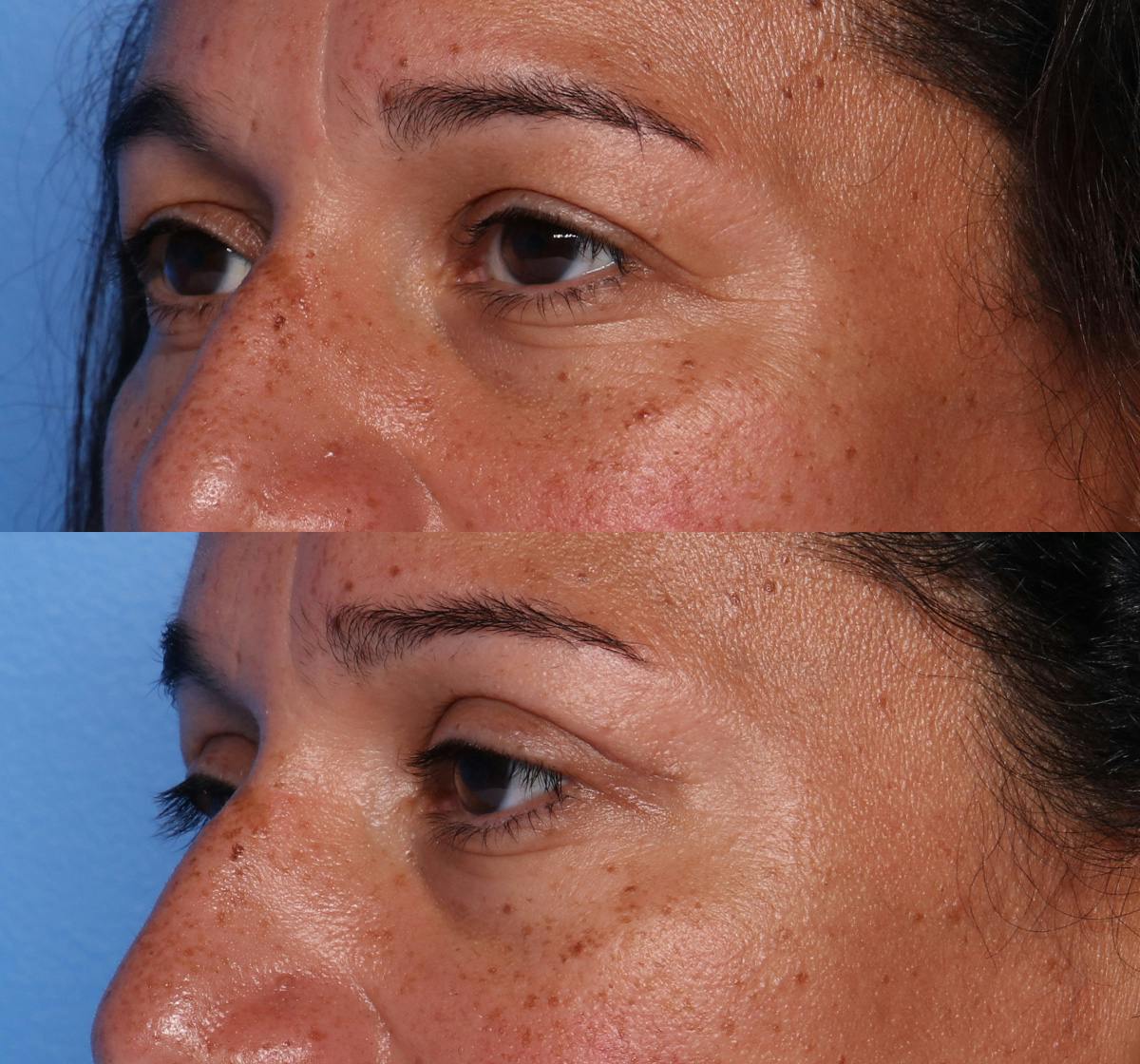 Blepharoplasty Before & After Gallery - Patient 289412 - Image 3