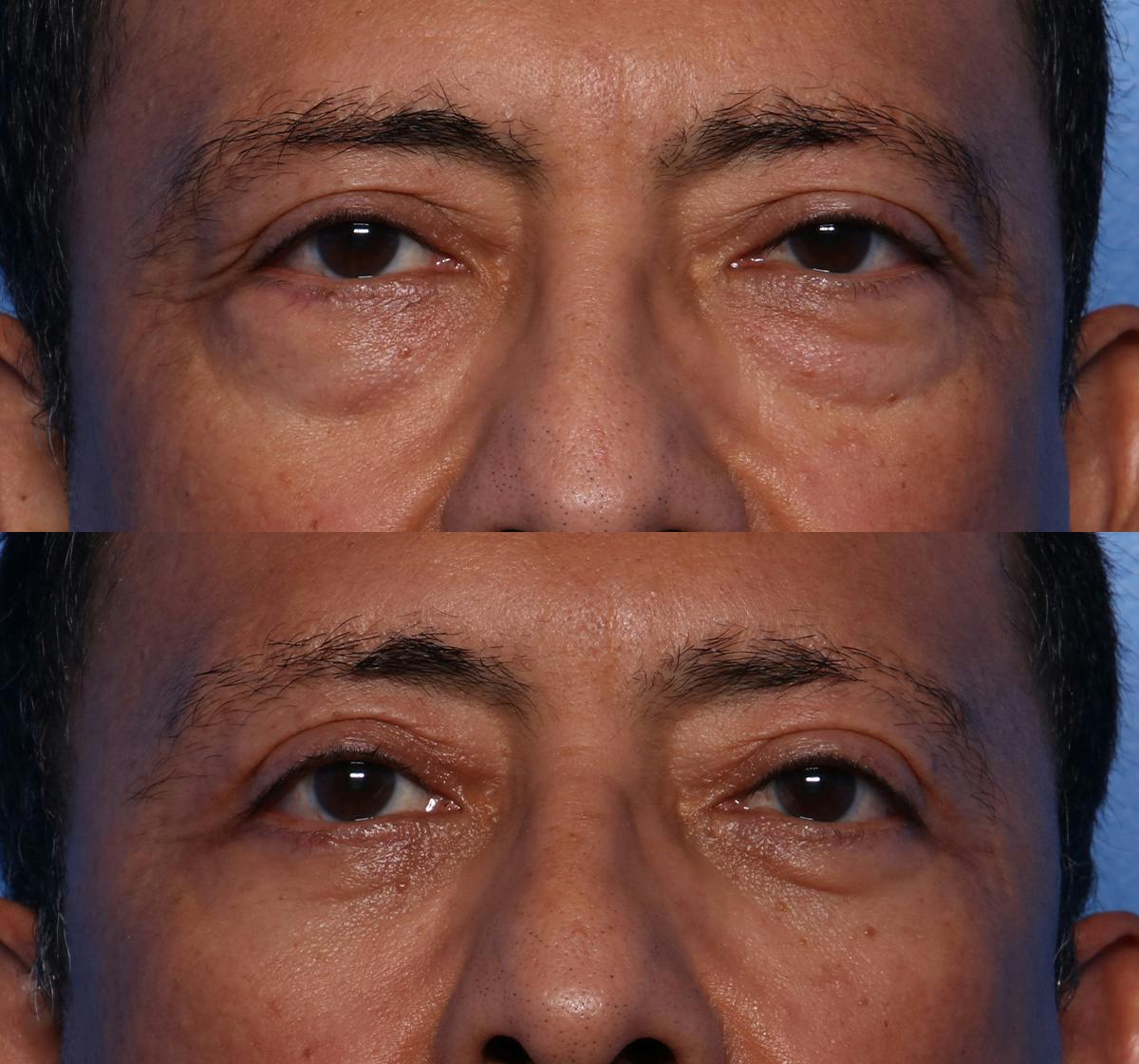 Blepharoplasty Before & After Gallery - Patient 398692 - Image 1