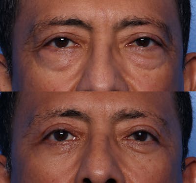 Blepharoplasty Before & After Gallery - Patient 398692 - Image 1