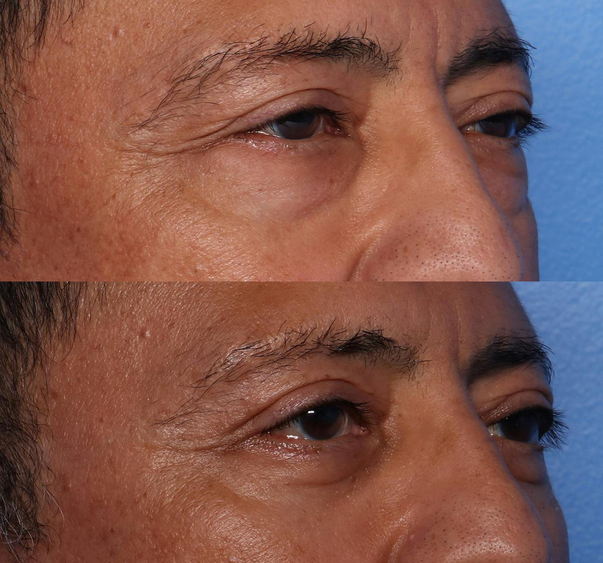 Blepharoplasty Before & After Gallery - Patient 398692 - Image 2