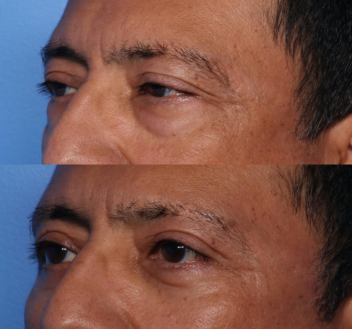 Blepharoplasty Before & After Gallery - Patient 398692 - Image 3