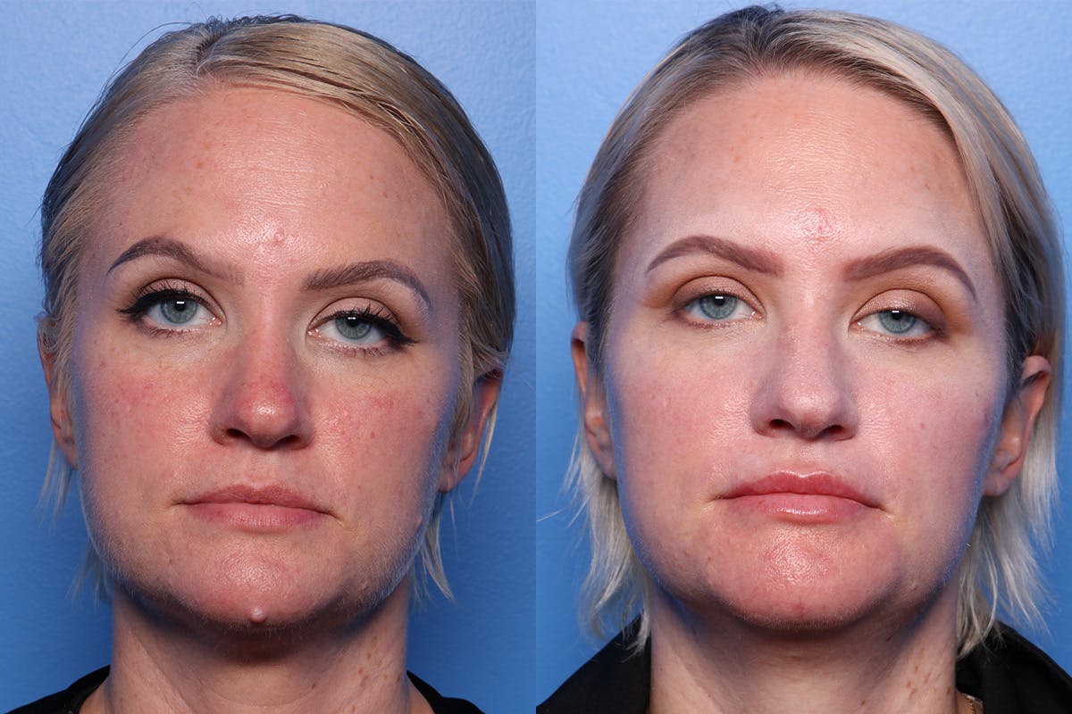 Mole Removal Before & After Gallery - Patient 334777 - Image 1