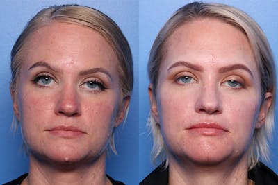 Mole Removal Before & After Gallery - Patient 334777 - Image 1