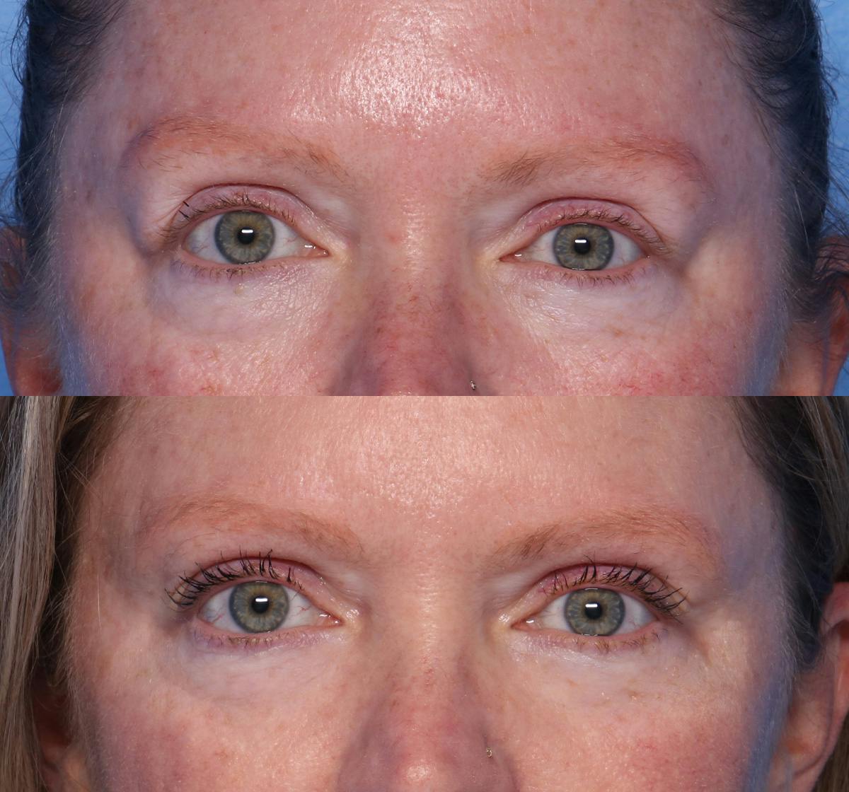 Blepharoplasty Before & After Gallery - Patient 294143 - Image 1