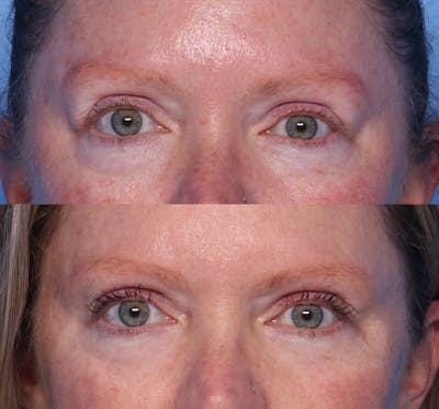 Blepharoplasty Before & After Gallery - Patient 294143 - Image 1