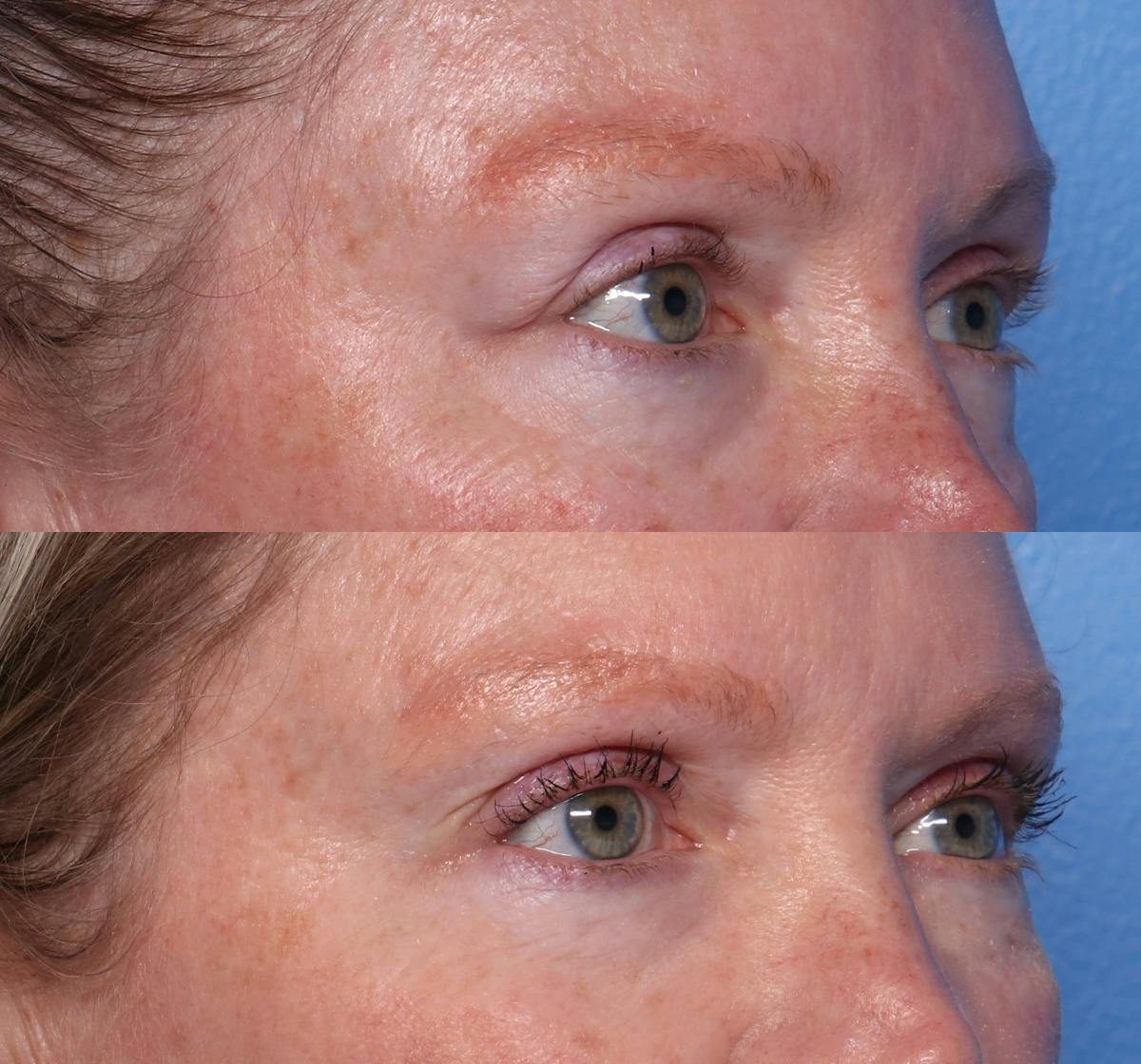 Blepharoplasty Before & After Gallery - Patient 294143 - Image 2