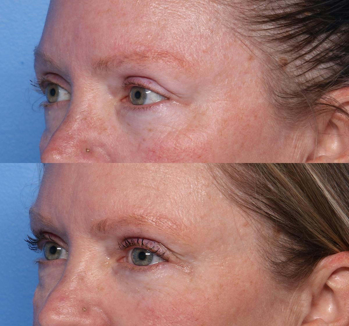 Blepharoplasty Before & After Gallery - Patient 294143 - Image 3