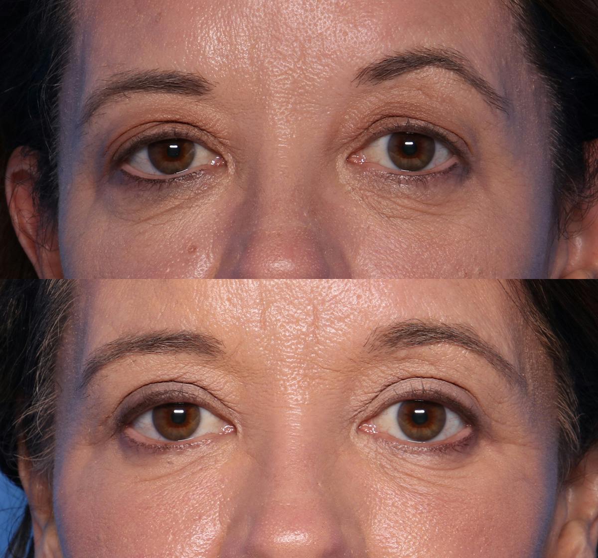 Blepharoplasty Before & After Gallery - Patient 269629 - Image 1