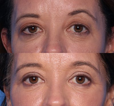 Blepharoplasty Before & After Gallery - Patient 269629 - Image 1