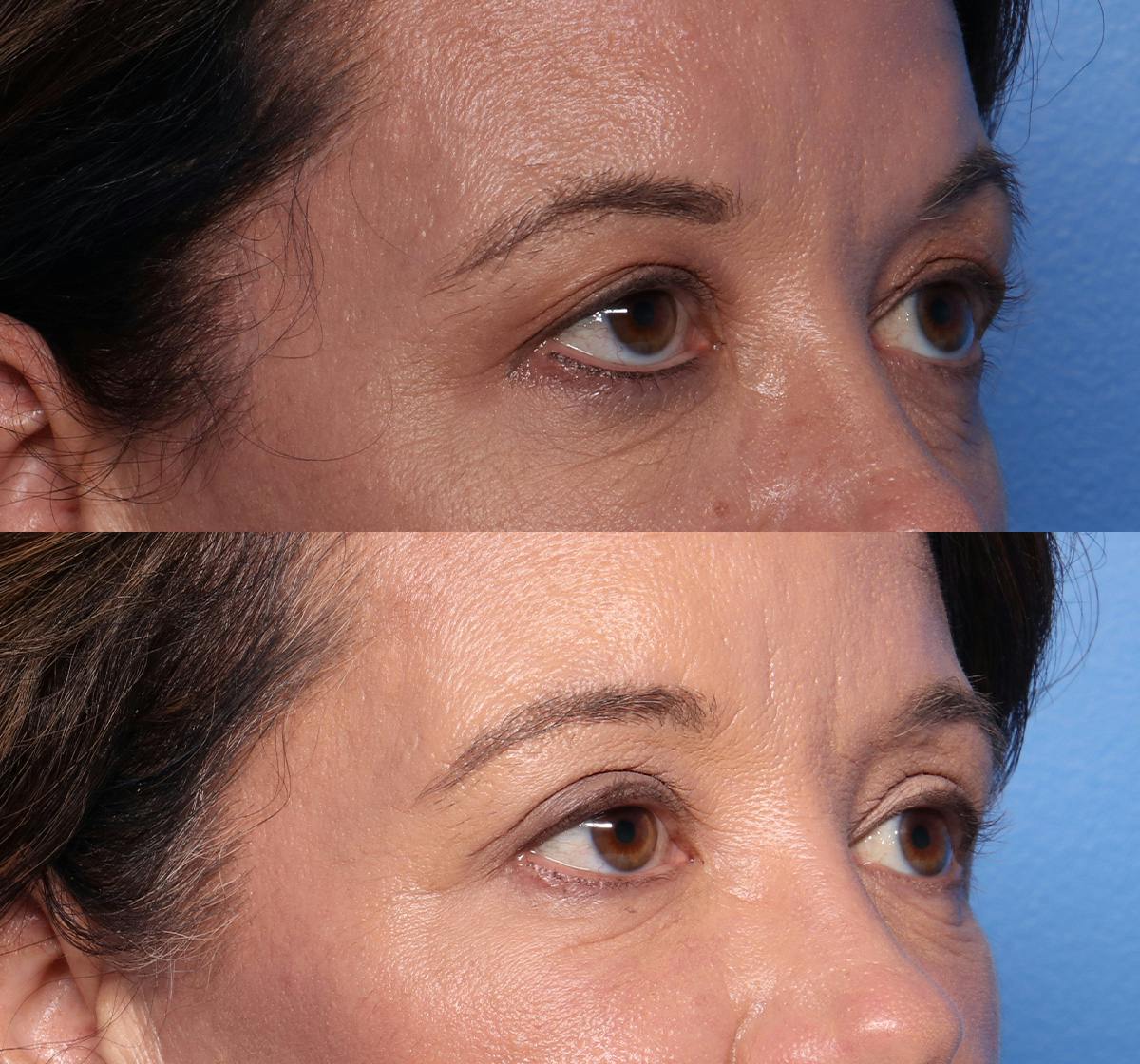 Blepharoplasty Before & After Gallery - Patient 269629 - Image 2