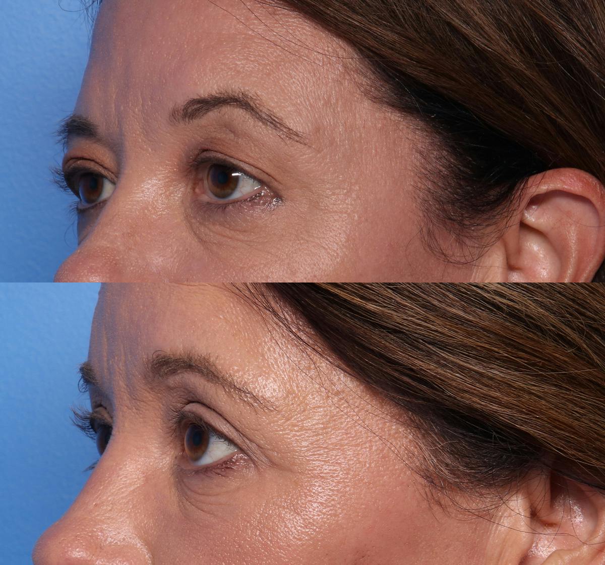 Blepharoplasty Before & After Gallery - Patient 269629 - Image 3