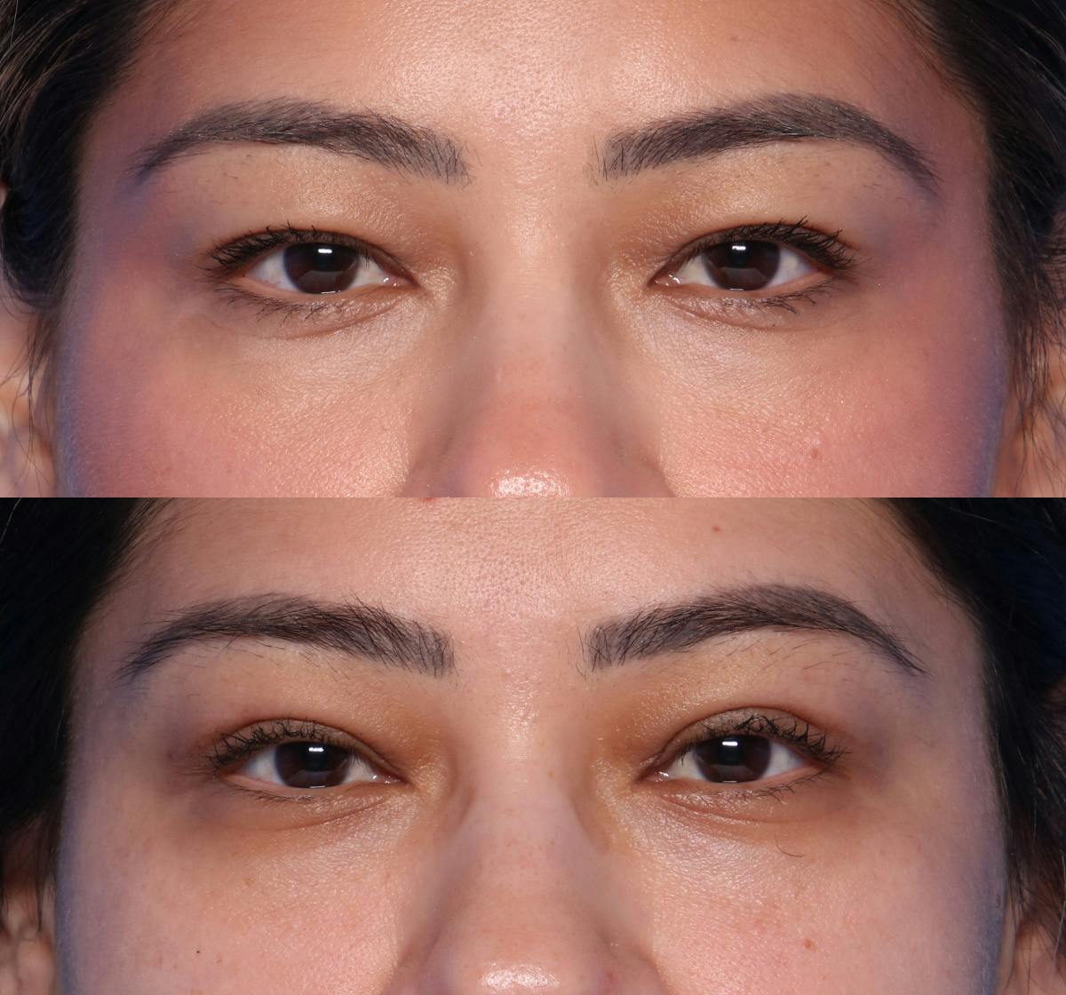Blepharoplasty Before & After Gallery - Patient 380529 - Image 1