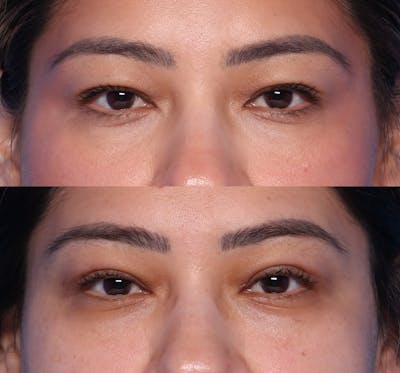 Blepharoplasty Before & After Gallery - Patient 380529 - Image 1