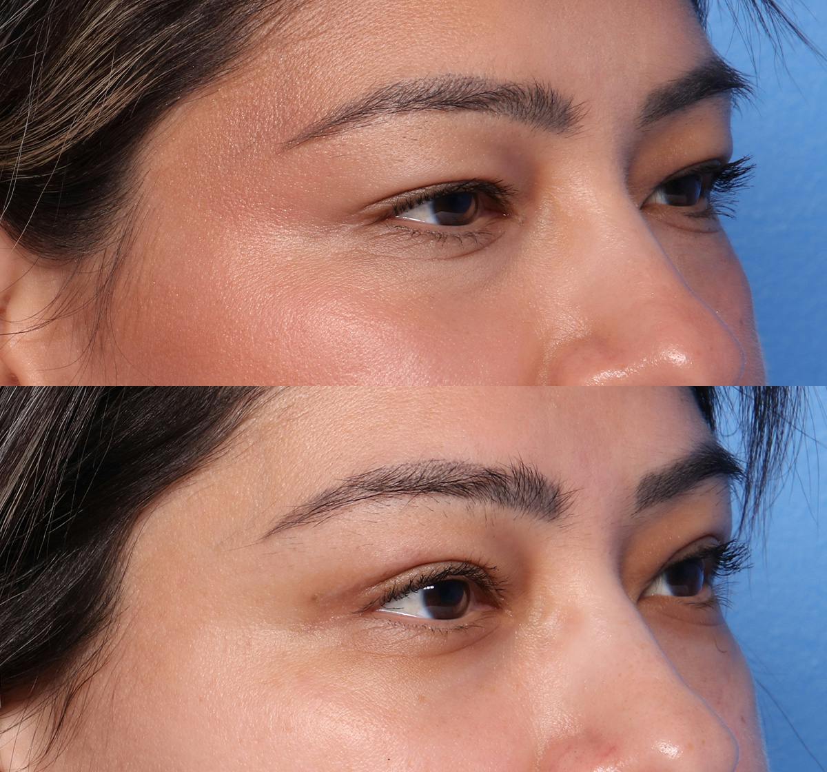 Blepharoplasty Before & After Gallery - Patient 380529 - Image 2