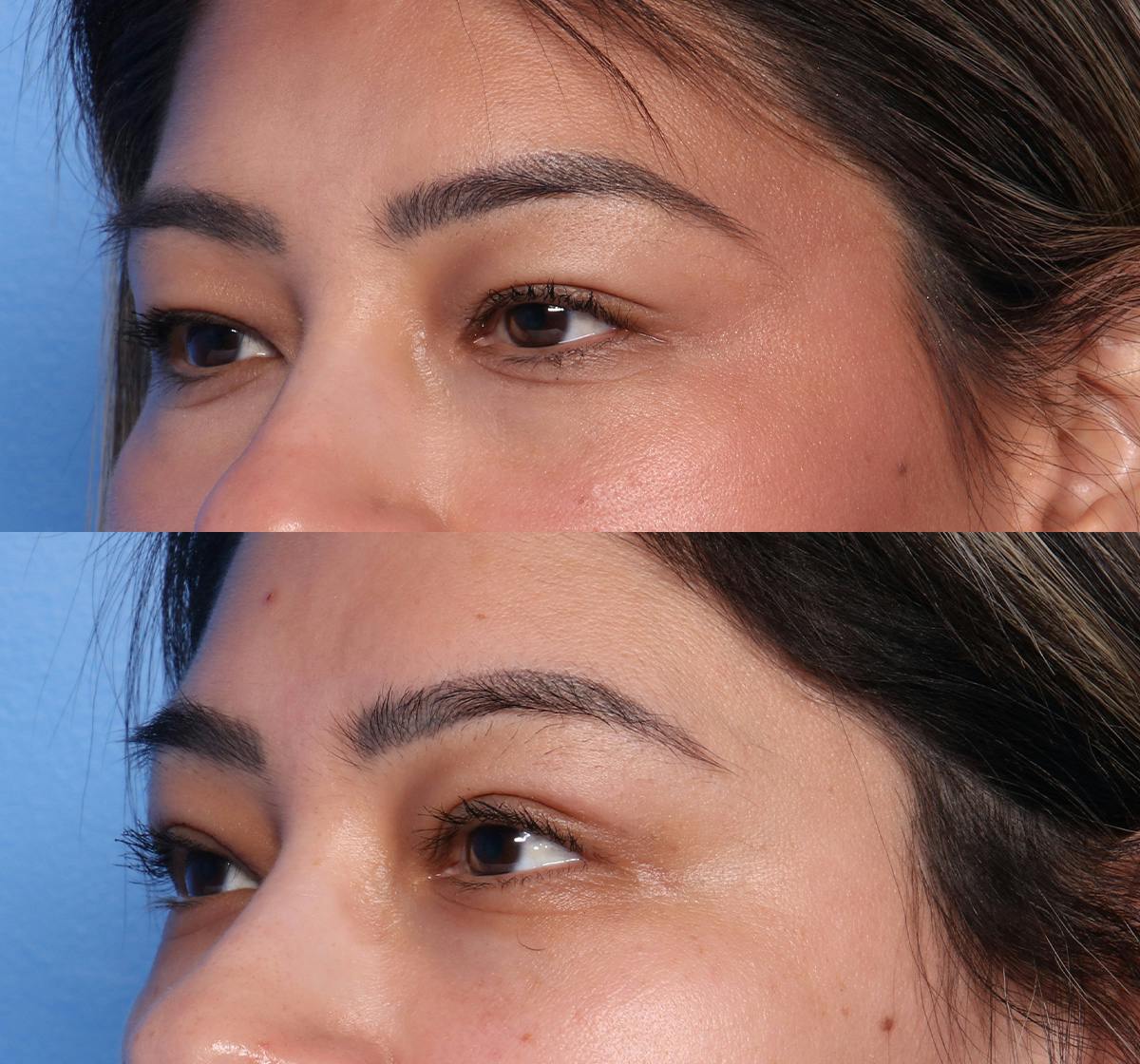 Blepharoplasty Before & After Gallery - Patient 380529 - Image 3