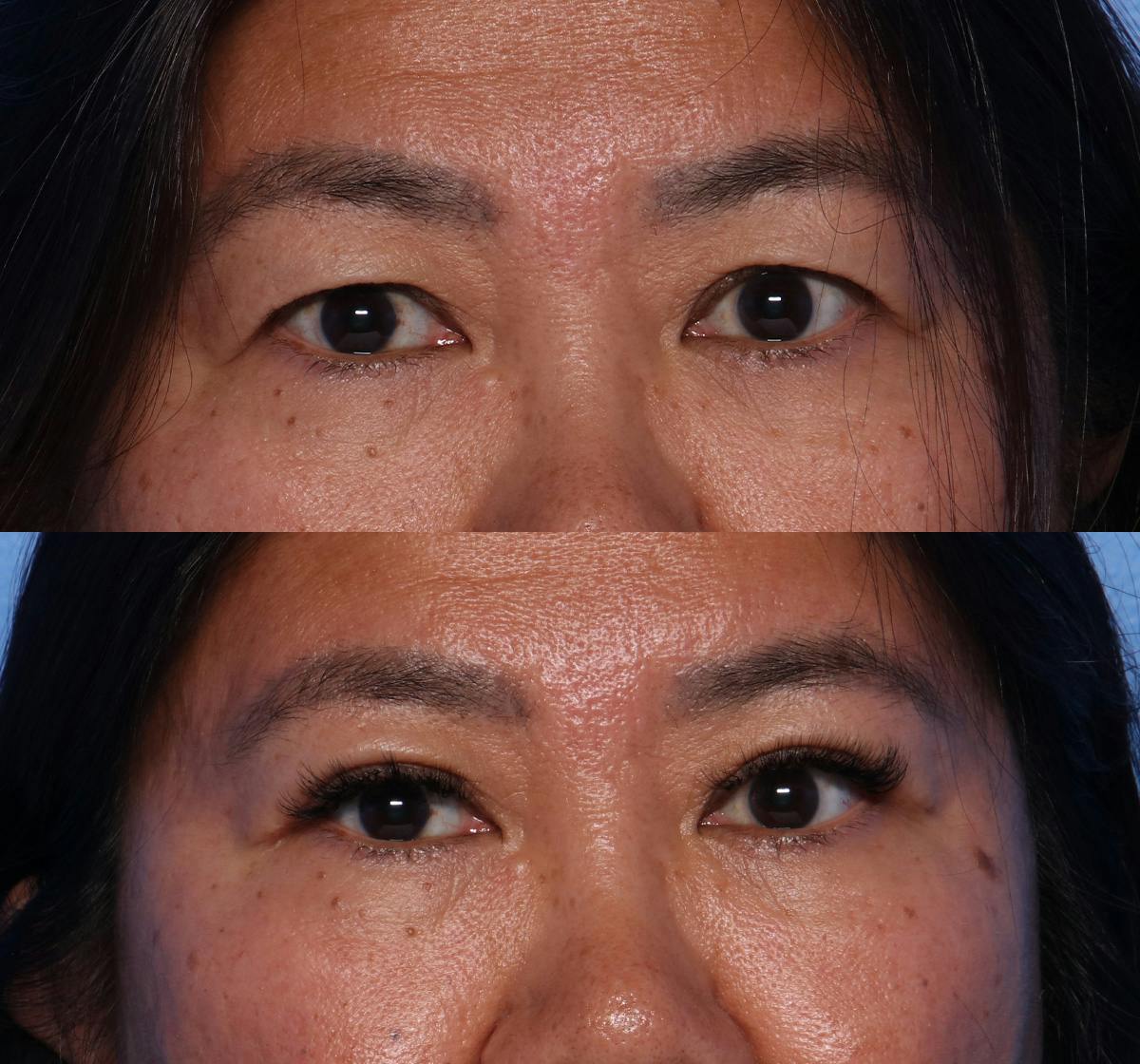 Blepharoplasty Before & After Gallery - Patient 400453 - Image 1