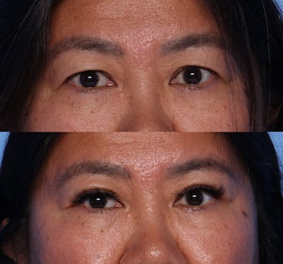 Blepharoplasty Before & After Gallery - Patient 400453 - Image 1