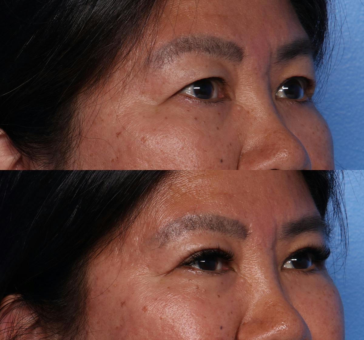 Blepharoplasty Before & After Gallery - Patient 400453 - Image 2