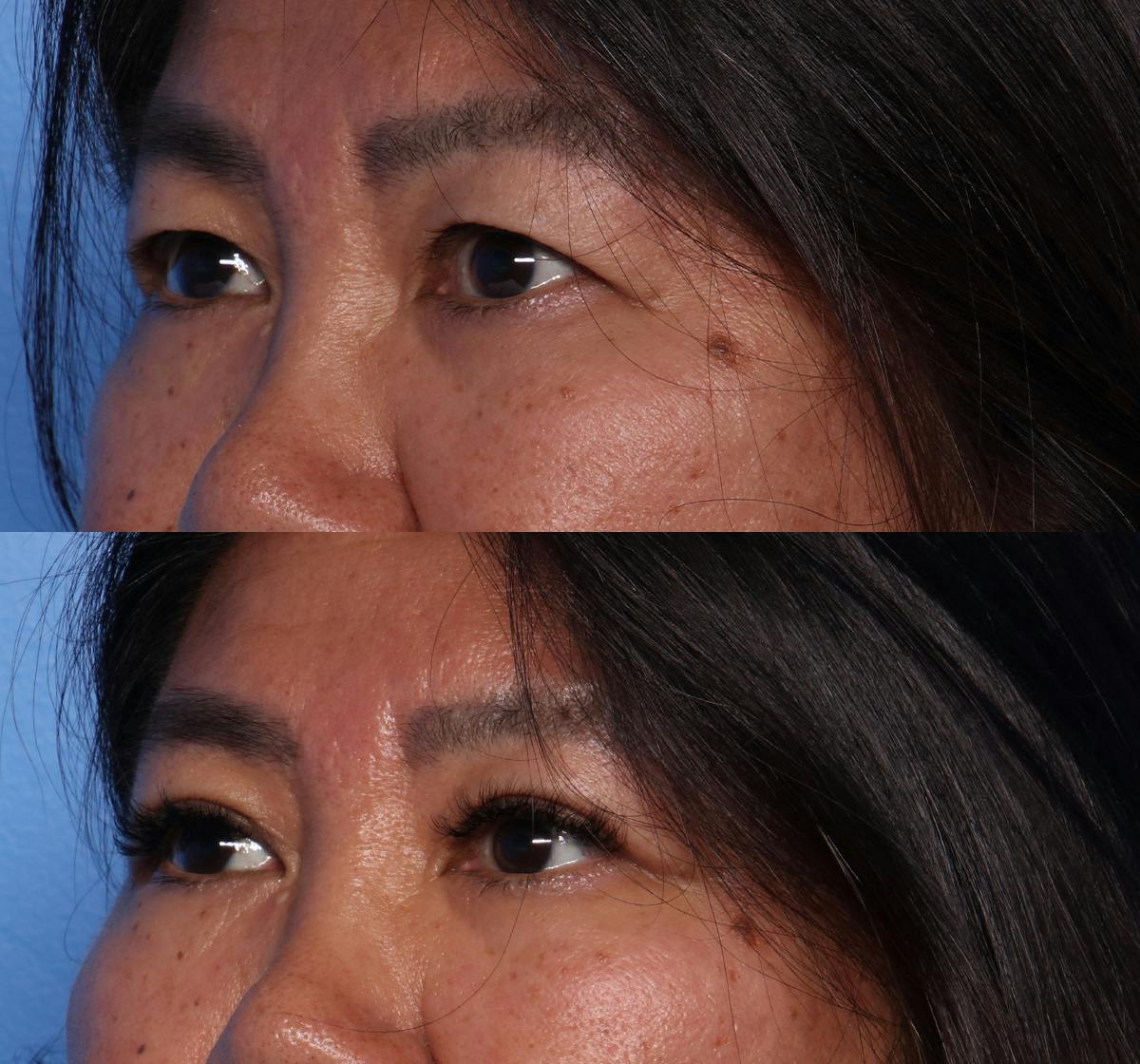 Blepharoplasty Before & After Gallery - Patient 400453 - Image 3