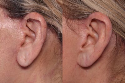 Earlobe Repair Before & After Gallery - Patient 144429 - Image 1