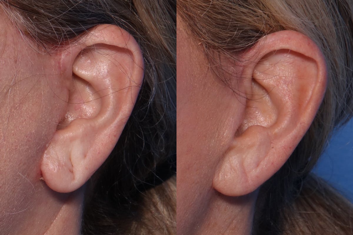 Earlobe Repair Before & After Gallery - Patient 144429 - Image 2