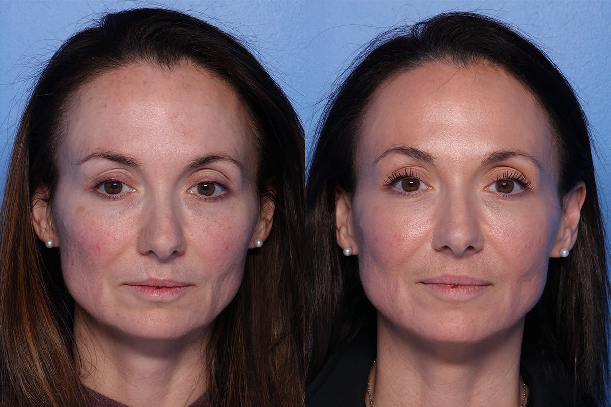 CO2 Laser Resurfacing Before & After Gallery - Patient 138041 - Image 1