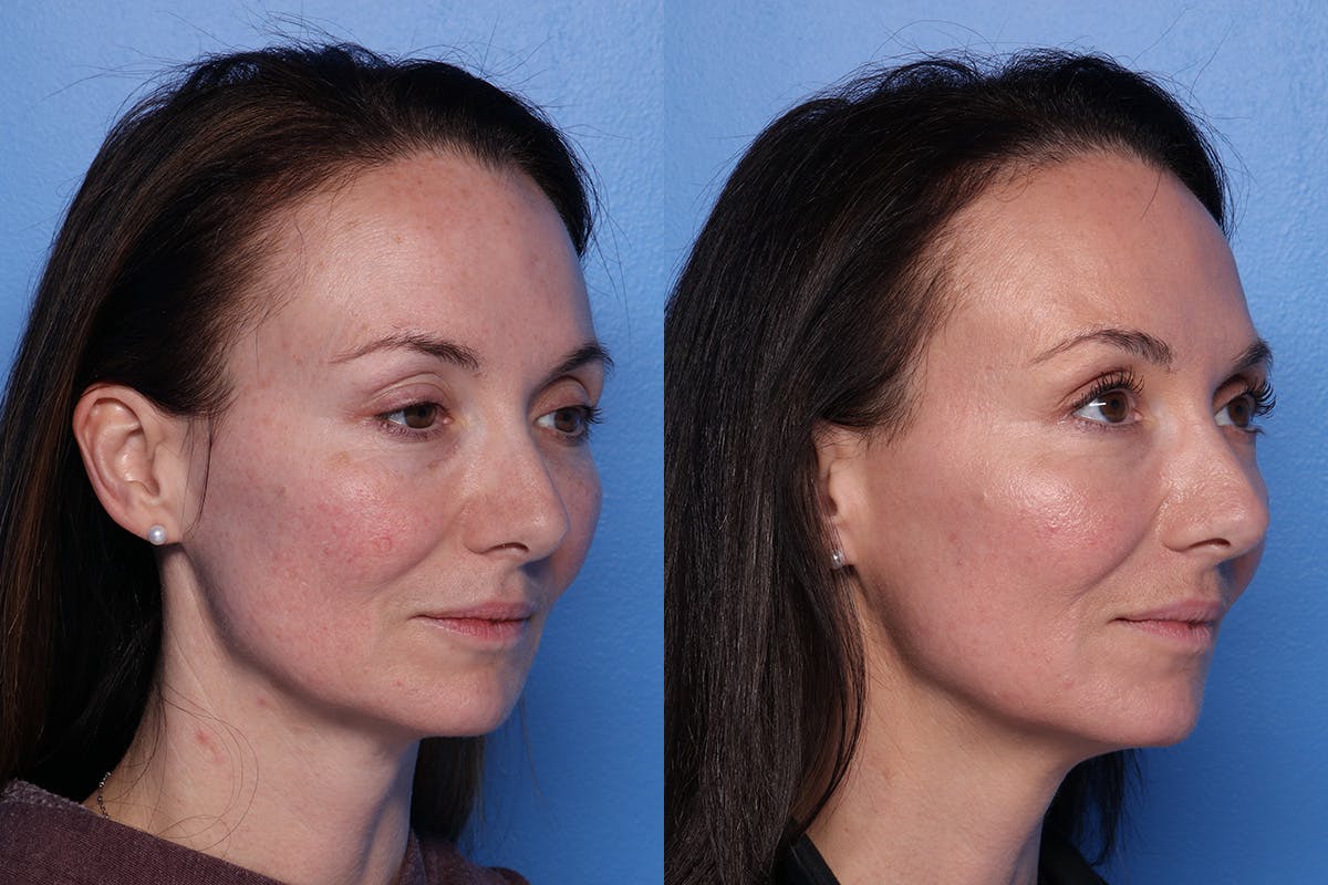 CO2 Laser Resurfacing Before & After Gallery - Patient 138041 - Image 2