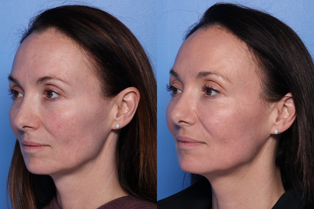 CO2 Laser Resurfacing Before & After Gallery - Patient 138041 - Image 3