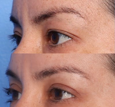 Blepharoplasty Before & After Gallery - Patient 187610 - Image 1