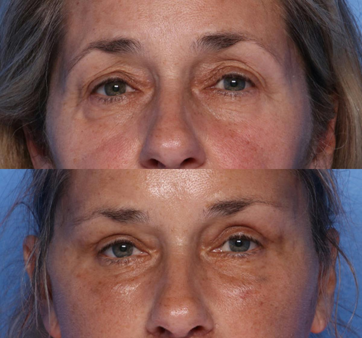 Brow Lift Before & After Gallery - Patient 177282 - Image 1