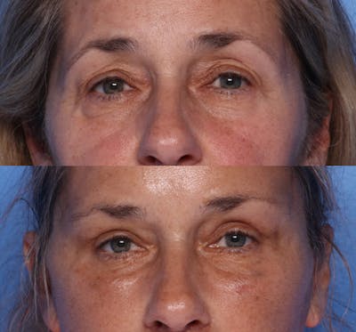 Brow Lift Before & After Gallery - Patient 177282 - Image 1